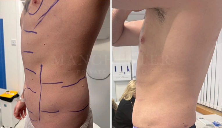 vaser lipo male abs before and after