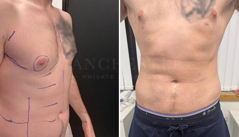 vaser lipo male abs before and after