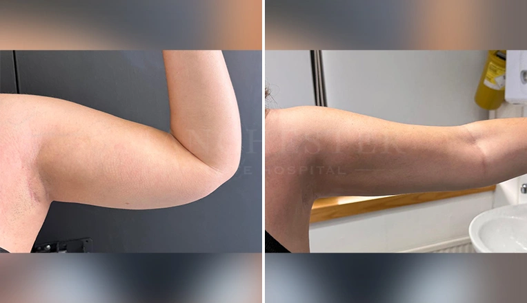 vaser liposuction arms before and after patient-13