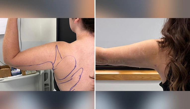 vaser liposuction arms before and after patient-13