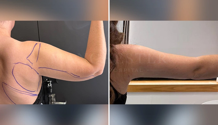 vaser liposuction arms before and after patient-13