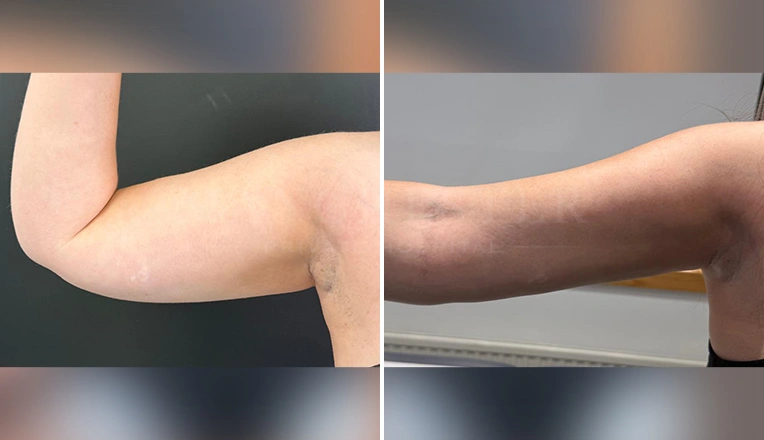 vaser liposuction arms before and after patient-13