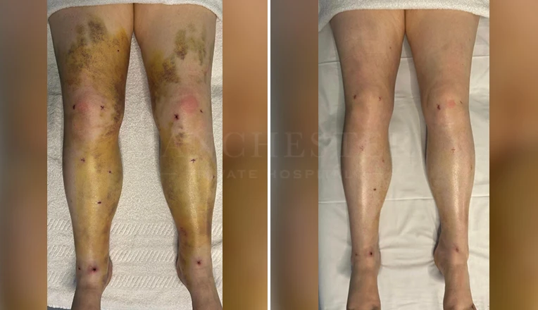 3 weeks post-liposuction MLD massage before and after
