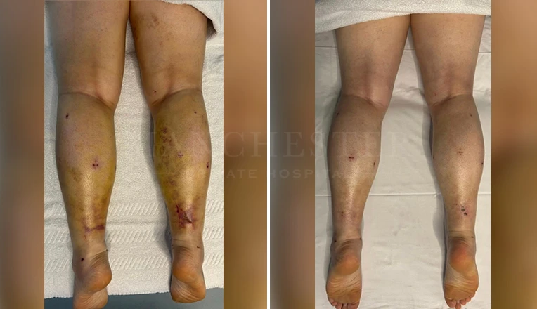 3 weeks post-liposuction MLD massage before and after