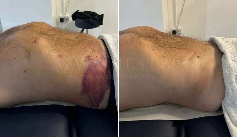 4 sessions of MLD massages post-liposuction