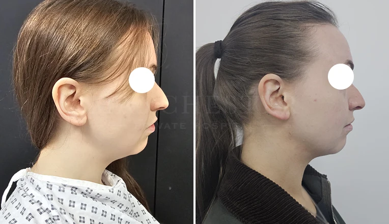 chin vaser liposuction before and after