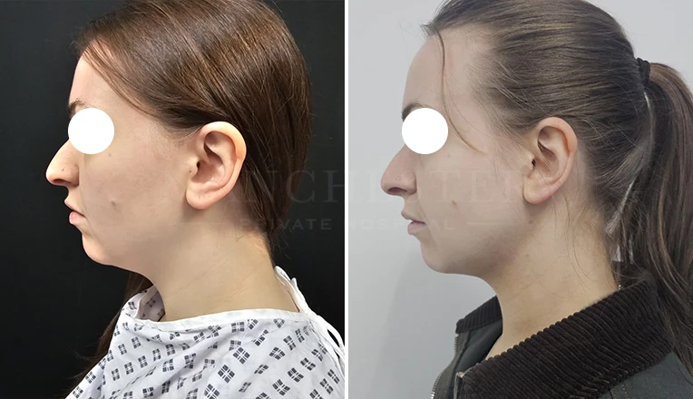chin vaser liposuction before and after