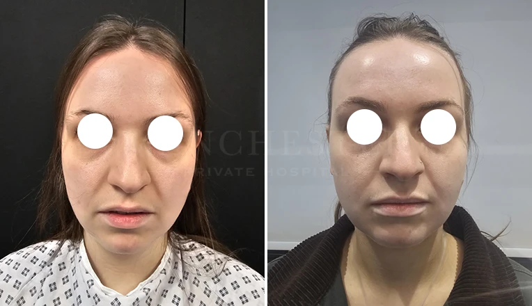 chin vaser liposuction before and after