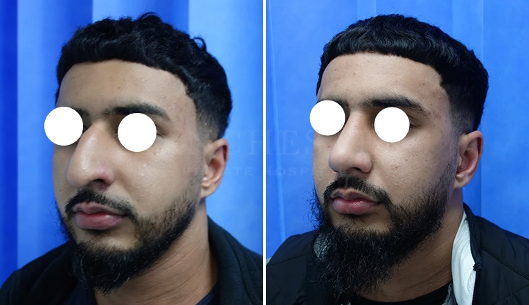 open septorhinoplasty before and after result