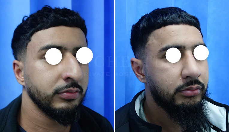 open septorhinoplasty before and after result