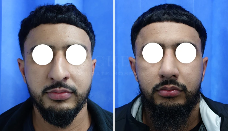 open septorhinoplasty before and after result