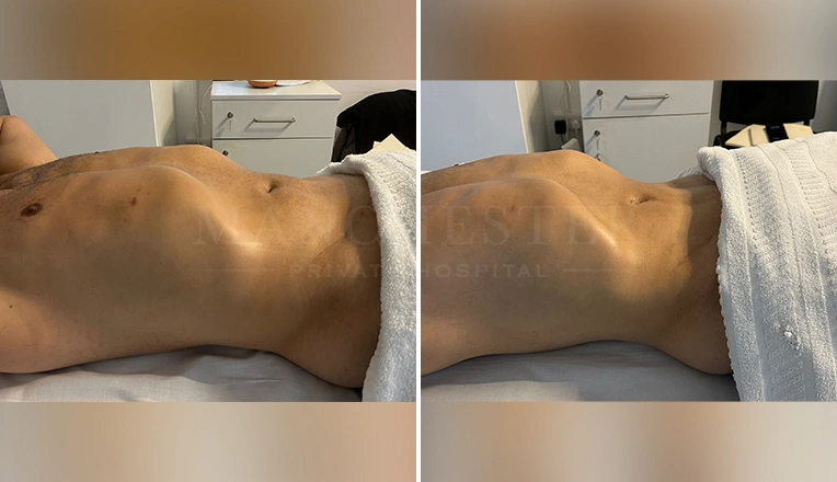 4 MLD massage after 3 weeks post op vaser liposuction on abdomen