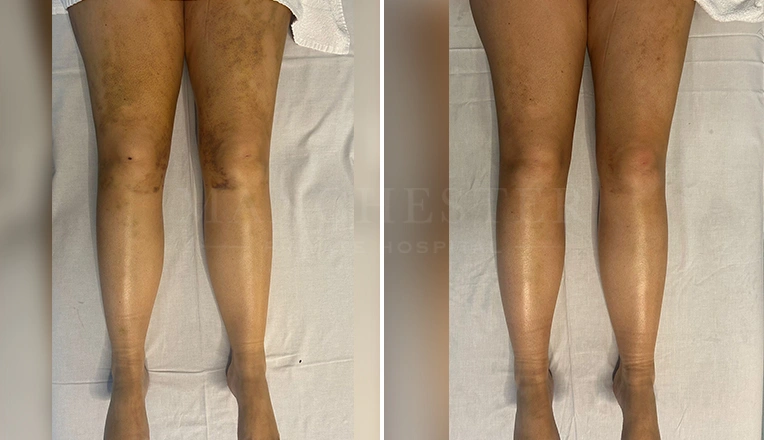 6 MLD massage after 3 weeks post-liposuction