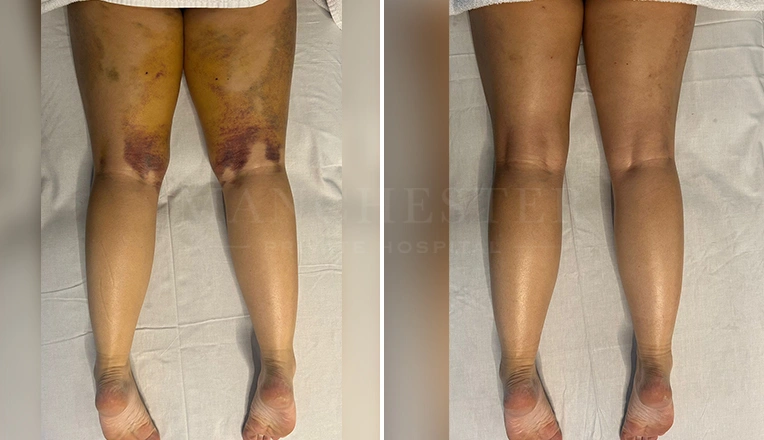 6 MLD massage after 3 weeks post-liposuction