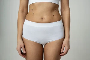 Vaser Liposuction Scars Explained: Placement, Healing and Aftercare