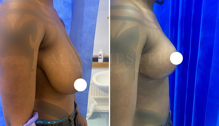 breast reduction before and after result