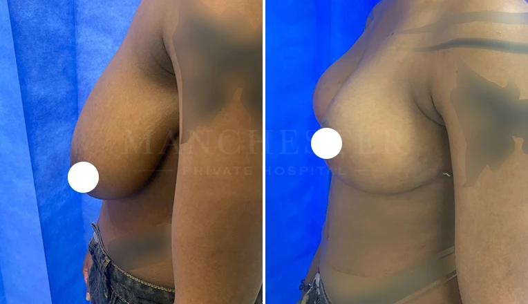 breast reduction before and after result