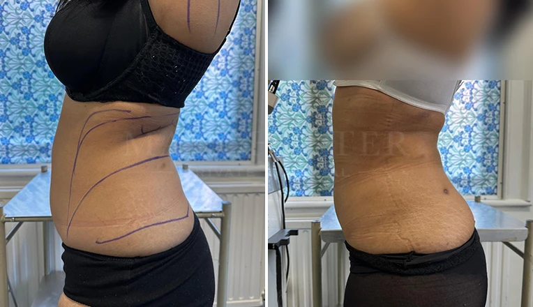 Vaser Liposuction on Back and flanks, Under armpit and bra rolls Before and After