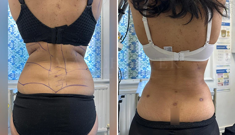 Vaser Liposuction on Back and flanks, Under armpit and bra rolls Before and After