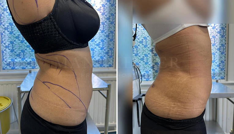 Vaser Liposuction on Back and flanks, Under armpit and bra rolls Before and After