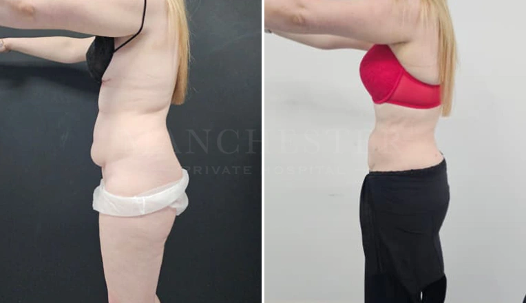 Vaser Liposuction Upper lower abdomen & flanks Before and After