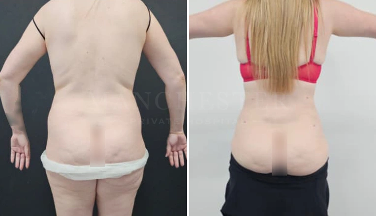 Vaser Liposuction Upper lower abdomen & flanks Before and After