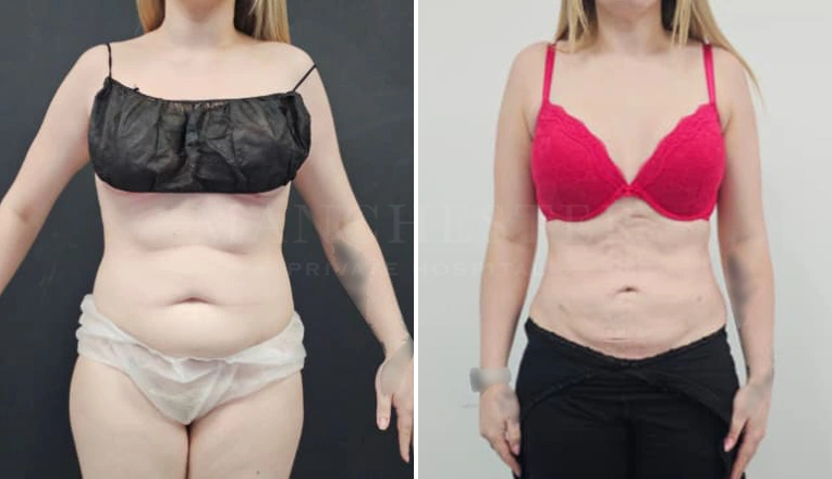 Vaser Liposuction Upper lower abdomen & flanks Before and After