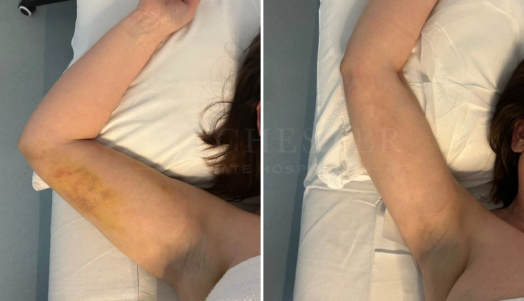 4 MLD massage session after liposuction on arm before and after