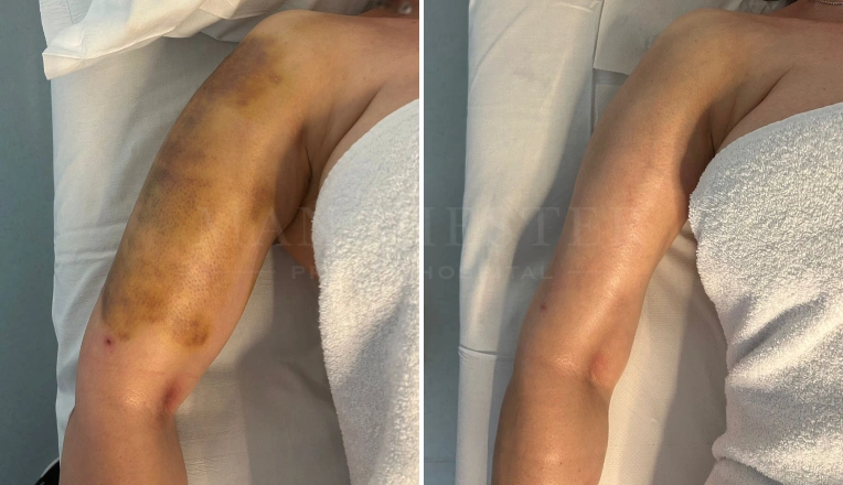 4 MLD massage session after liposuction on arm before and after