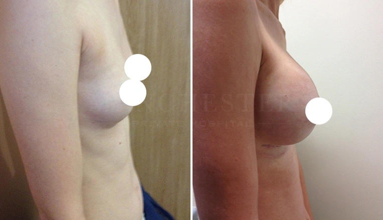 boob job before and after