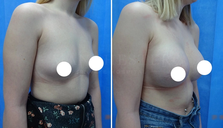 boob job before and after
