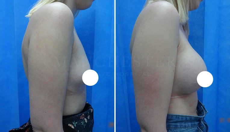 boob job before and after