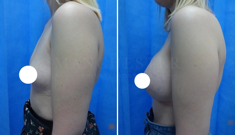 boob job before and after