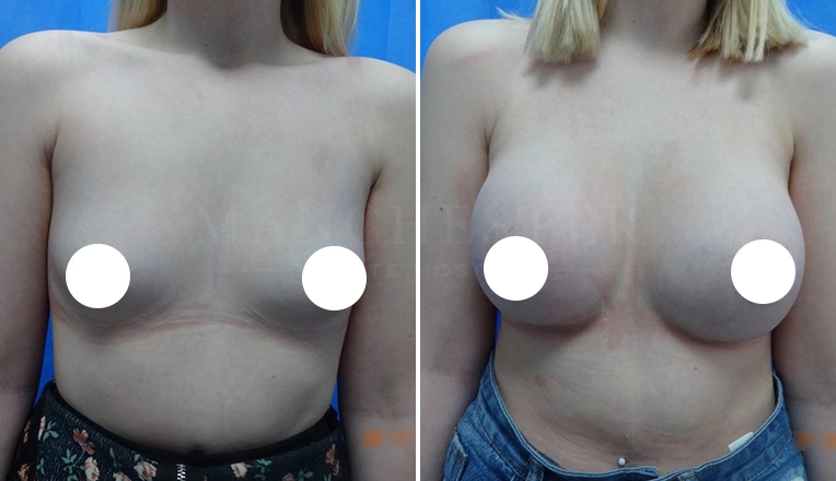 boob job before and after