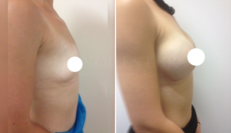 breast enlargement before and after uk