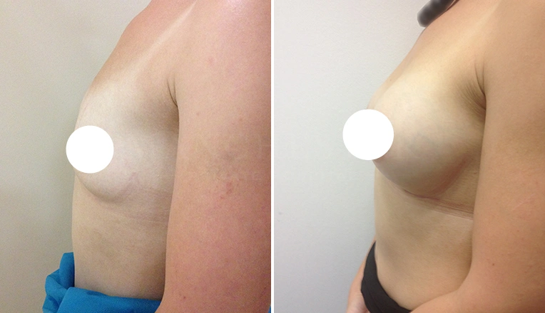 breast enlargement before and after uk