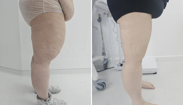upper legs vaser liposuction before and after patient result