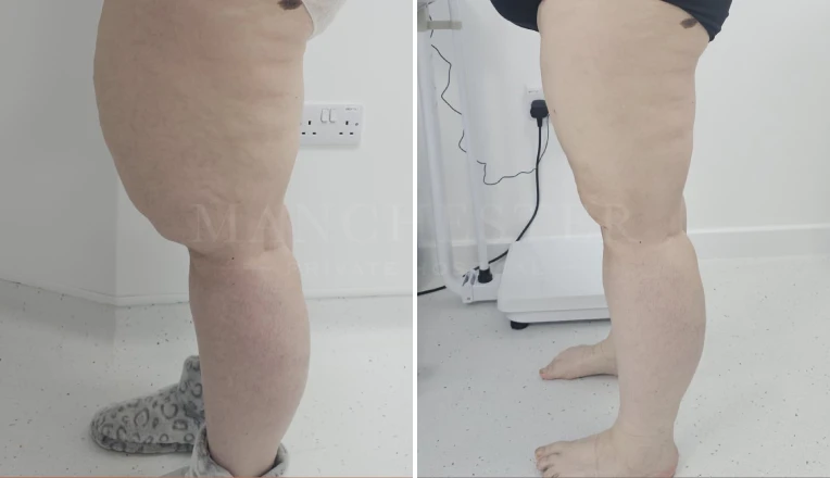 upper legs vaser liposuction before and after patient result