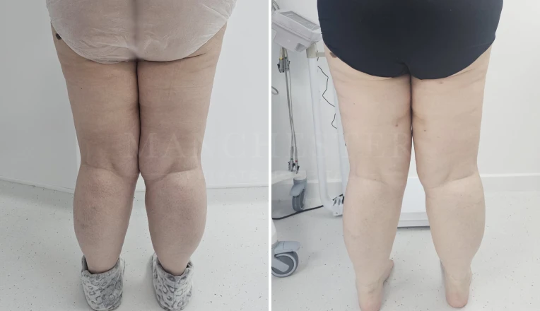 upper legs vaser liposuction before and after patient result