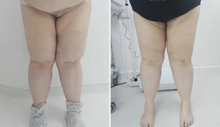 upper legs vaser liposuction before and after patient result