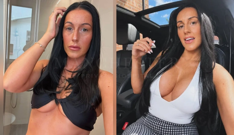 500cc Breast Implants Before and After Result