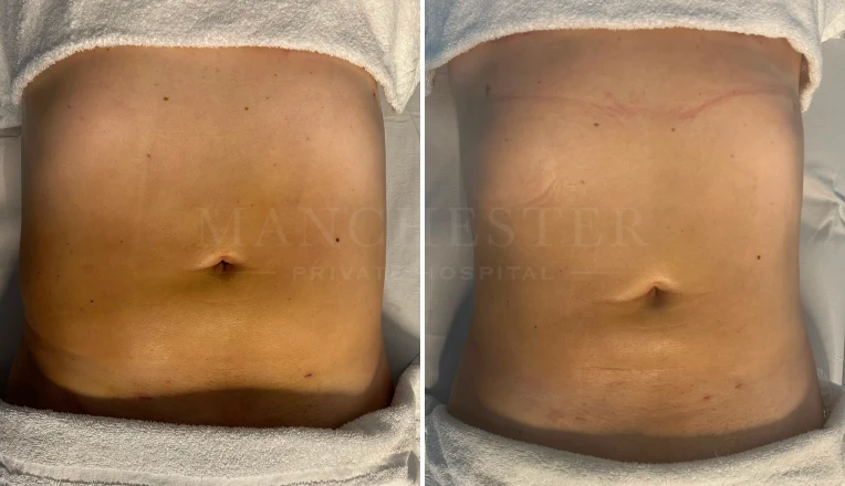 Post op Liposuction on Abdomen and flanks, 6 sessions of MLD massages