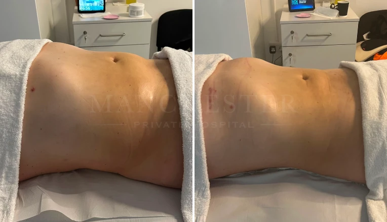 Post op Liposuction on Abdomen and flanks, 6 sessions of MLD massages