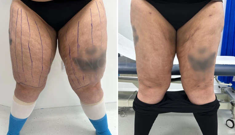 frontal thighs lipedema liposuction before and after result