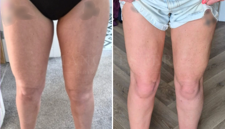 Thigh vaser lipo before and after patient