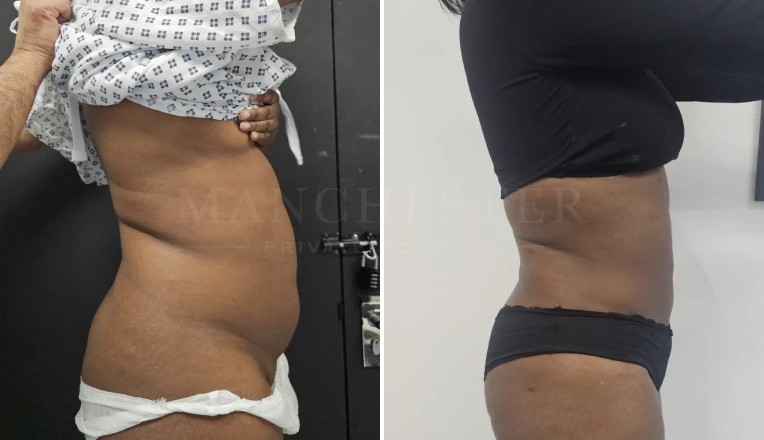Vaser Liposuction Upper and lower abdomen & flanks Before and After