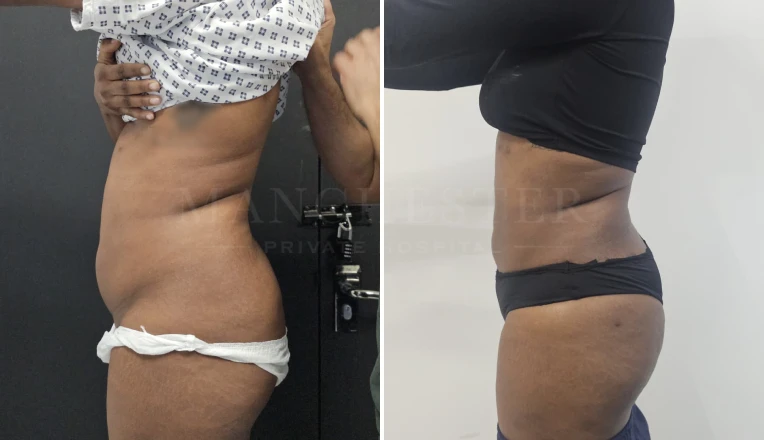 Vaser Liposuction Upper and lower abdomen & flanks Before and After