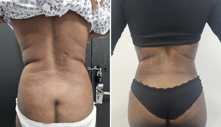 Vaser Liposuction Upper and lower abdomen & flanks Before and After