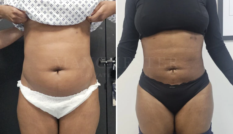 Vaser Liposuction Upper and lower abdomen & flanks Before and After