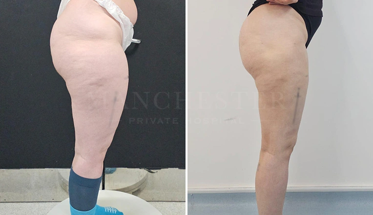 leg liposuction before and after